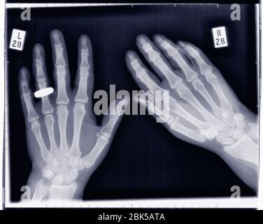 Hands with wedding ring on left hand, X-ray. Stock Photo