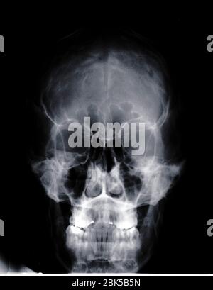 Human skull, X-ray. Stock Photo
