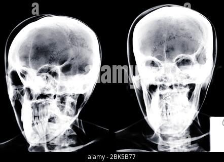 Two human skulls, X-ray. Stock Photo