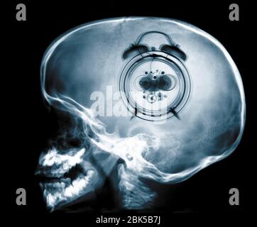 Human skull and clock, X-ray. Stock Photo