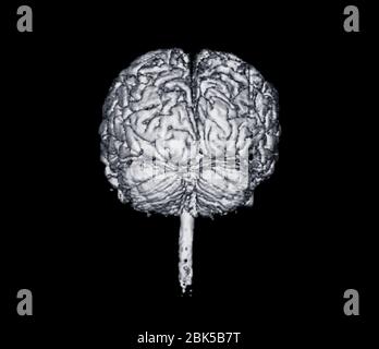 Front view of brain, X-ray. Stock Photo