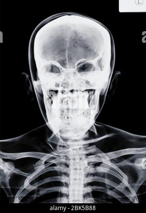 Human skull, X-ray. Stock Photo