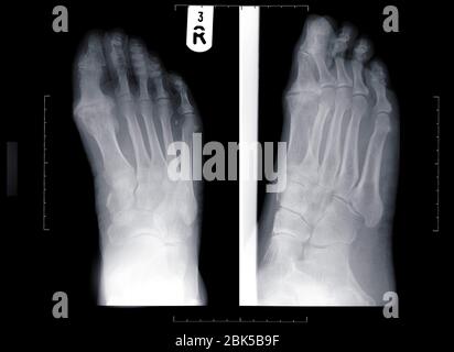 Human feet, X-ray. Stock Photo