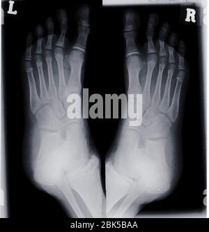 Human feet, X-ray. Stock Photo