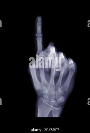 Hand holding up an index finger, X-ray. Stock Photo