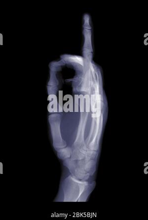 Hand holding up an index finger, X-ray. Stock Photo