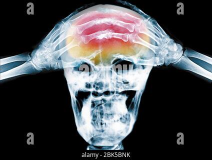 Person with hands on their head, headache, coloured X-ray. Stock Photo