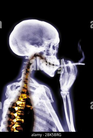 Person smoking, coloured X-ray. Stock Photo