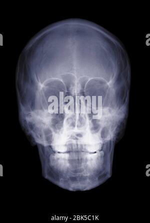Human skull, X-ray. Stock Photo