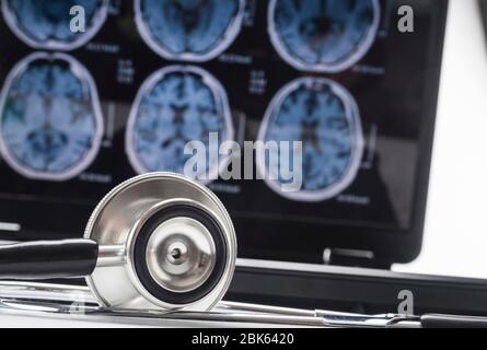 Scientific analysis of Alzheimer's disease in hospital, conceptual image Stock Photo
