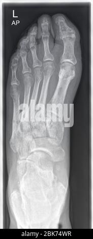 radiograph, x-ray image of a human left foot Stock Photo