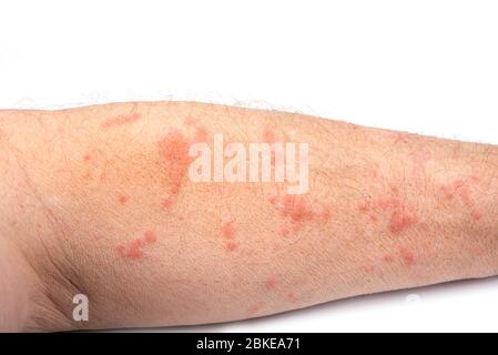 Skin disease rash on a man arm Stock Photo