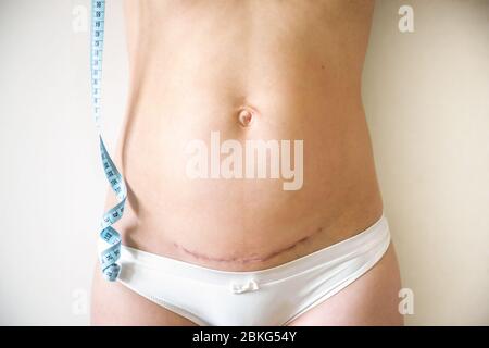 Woman with cesarean section after childbirth and tape measure Stock Photo