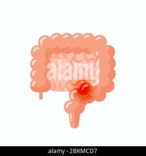 Flat vector illustration of sick human intestine, cartoon style illustration Stock Vector