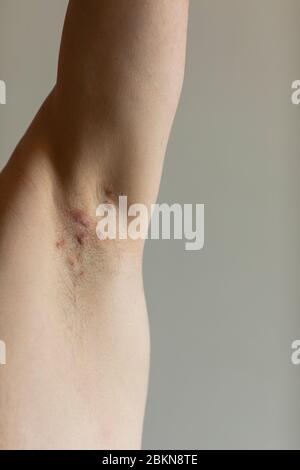 Patient diagnosed with Crohn’s disease with hidradenitis suppurativa under his armit with visible red painful fistulas. Irritated skin and hair follic Stock Photo
