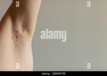 A patient diagnosed with Crohn’s disease with hidradenitis suppurativa under his armit with visible red painful fistulas. Irritated skin and hair foll Stock Photo