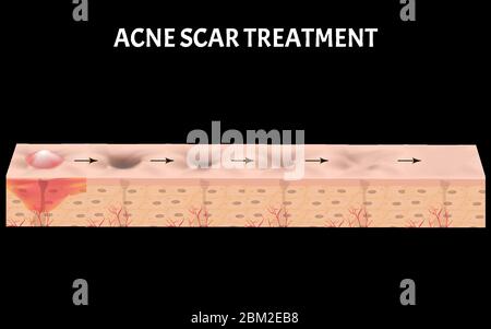 Types of scars. Acne scars. Keloid, hypertrophic, atrophic ...