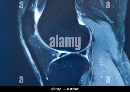 Knee sports injury mri mcl grade 2 tear magnetic resonance imaging ...