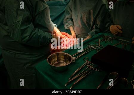 a surgical team performs a surgical abdominal operation Stock Photo