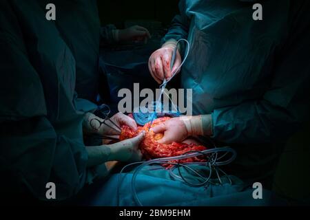 a surgical team performs a surgical abdominal operation Stock Photo