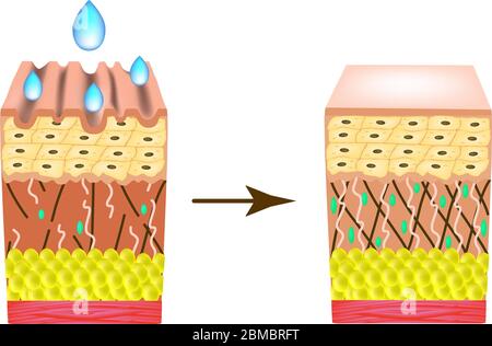Wrinkles on the skin. Collagen deficiency. Impact on the skin with a ...