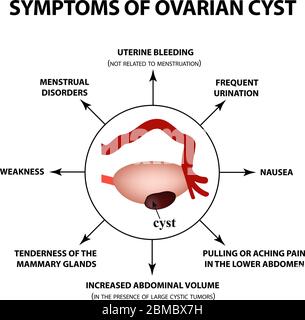 Symptoms of ovarian cyst. ovaries structure. Infographics. Vector illustration on isolated background. Stock Vector