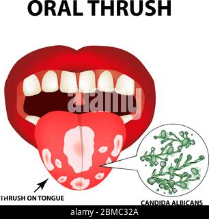 Oral thrush. Candidiasis on the tongue. Fungus in the mouth ...