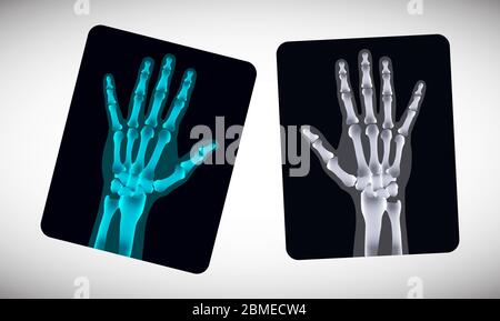 Radiography. Picture of human hands on the film. Vector Stock Vector