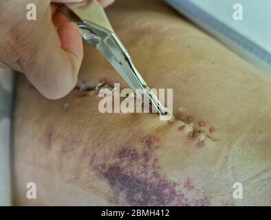 Incision, nurse removing surgical stainless steel staples,  total right hip  arthroplasty surgery. Stock Photo