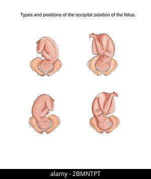 Illustration of the types and positions of the occipital position of the fetus Stock Photo