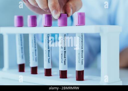 Male doctor hands holding blood Coronavirus or Covid 19 sample test for positive values. Corona Virus - 2019-NCOV Pandemic Respiratory disease. Stock Photo