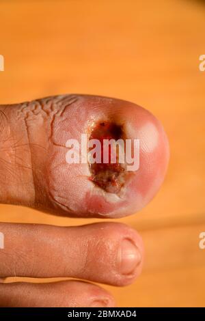 A toe after having an operation to remove a in-grown toenail removing dressing to wash and treat and let dry out before reapplying dressing. Stock Photo