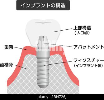 Dental implant flat vector illustration Stock Vector