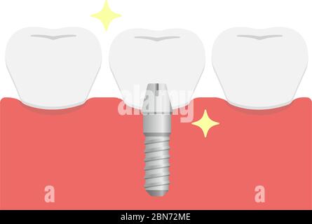 Dental implant flat vector illustration / Set artificial teeth (crown) Stock Vector