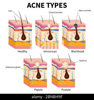 Acne types. Pimple skin diseases anatomy medical vector diagram. Illustration of follicle and pimple, medicine anatomy, papule and pustule Stock Vector