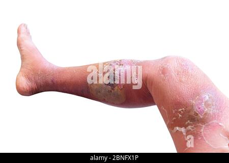 Erysipelas bacterial infection Under the skin leg aged people On white ...