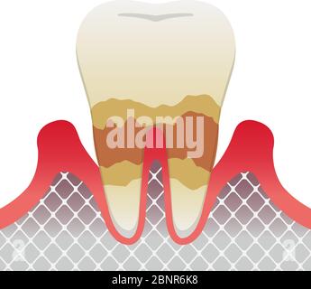 The stages of periodontitis disease / Moderate periodontitis Stock Vector