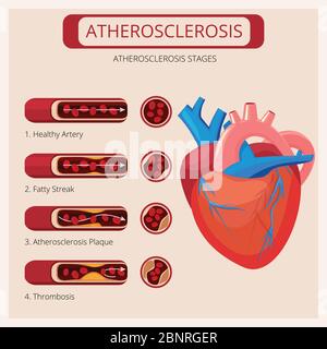 Atherosclerosis stages. Heart strokes thrombus attack blood circulatory system vector medical infographics Stock Vector