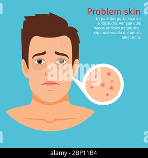 Young man face problem skin with acne, vector illustration Stock Vector