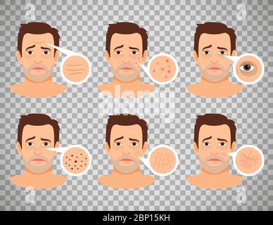 Man skin problems vector illustration. Male face with pimples and dark spots, wrinkles and acne isolated on transparent background Stock Vector