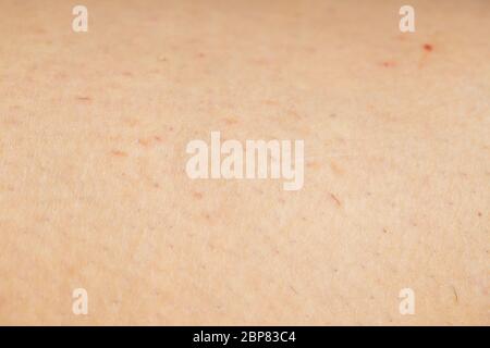Closeup of ingrown hair and irritated skin on the leg of a woman Stock  Photo - Alamy