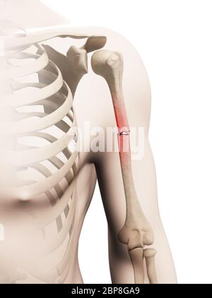 medical illustration of a borken arm bone Stock Photo