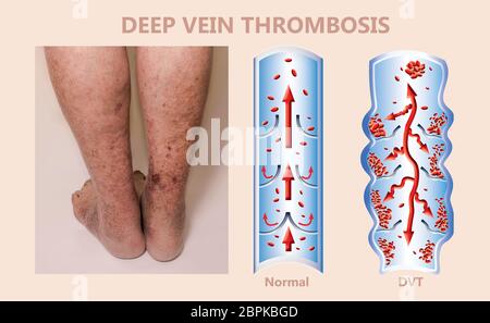 Economy class syndrome mechanism, deep vein thrombosis or DVT, Pulmonary Embolism or PE, coronary thrombosis, illustration diagram at male legs Stock Photo