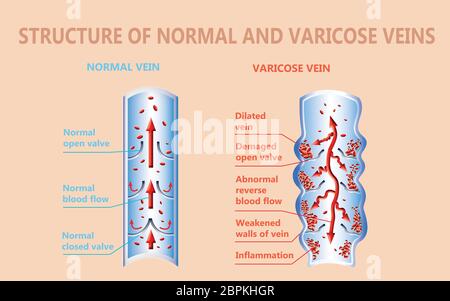 The structure of normal and varicose veins Stock Photo