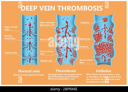 Thrombosis. From normal blood flow to blood clot formation and clot, that travels through the bloodstream. Embolism. Illustration for biological, medi Stock Photo