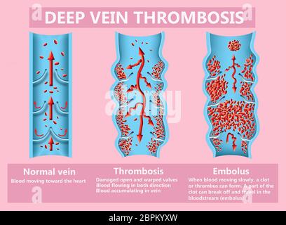 Thrombosis. From normal blood flow to blood clot formation and clot, that travels through the bloodstream. Embolism. Illustration for biological, medi Stock Photo
