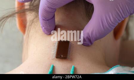 implantation of chip under the human skin. microchip is connected to the female body. Stock Photo