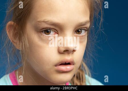 Conjunctivitis in front of a ten year old girl Stock Photo