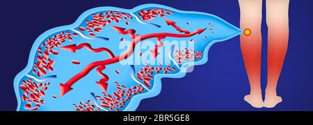 Varicose veins on a female senior legs. The structure of vein. DVT Stock Photo