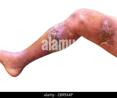 Erysipelas bacterial infection Under the skin leg aged people On white ...